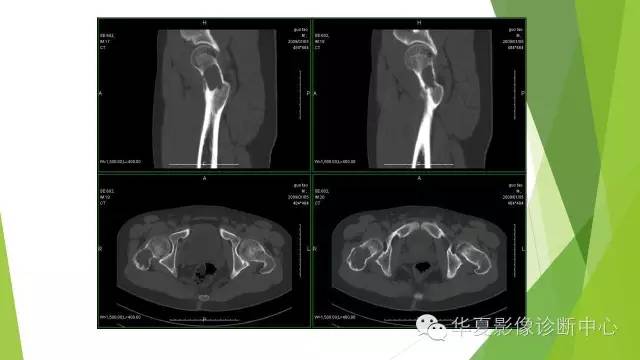 【病例】骨巨细胞瘤3例影像诊断与鉴别