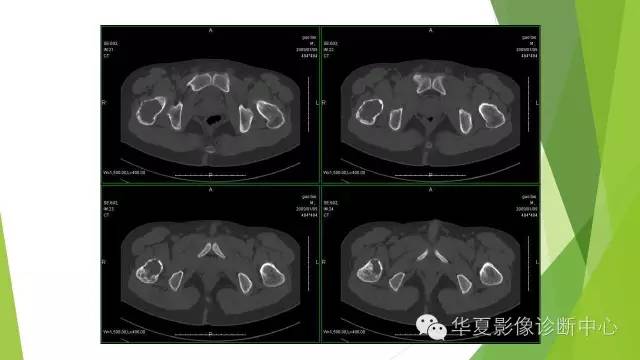 【病例】骨巨细胞瘤3例影像诊断与鉴别