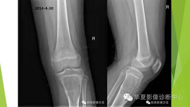 【病例】骨巨细胞瘤3例影像诊断与鉴别