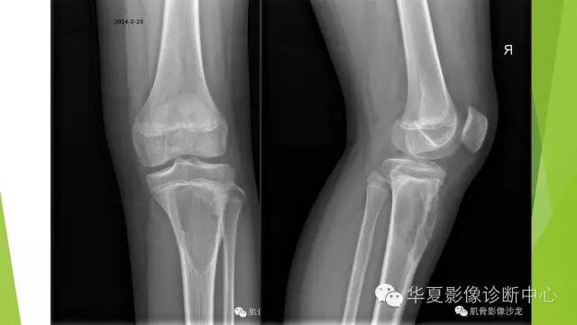 【病例】骨巨细胞瘤3例影像诊断与鉴别
