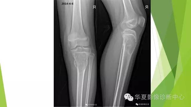 【病例】骨巨细胞瘤3例影像诊断与鉴别