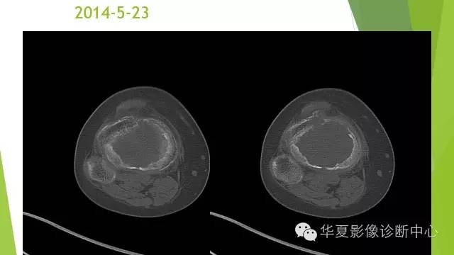 【病例】骨巨细胞瘤3例影像诊断与鉴别
