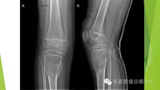 【病例】骨巨细胞瘤3例影像诊断与鉴别