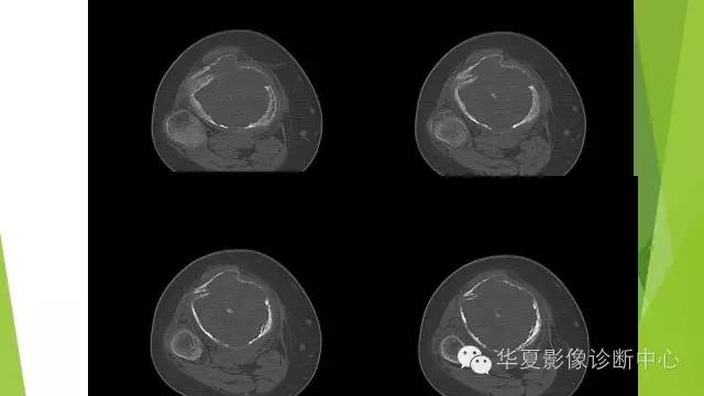 【病例】骨巨细胞瘤3例影像诊断与鉴别