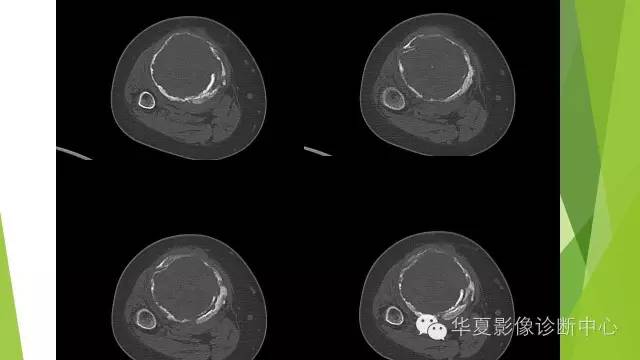 【病例】骨巨细胞瘤3例影像诊断与鉴别