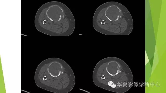 【病例】骨巨细胞瘤3例影像诊断与鉴别
