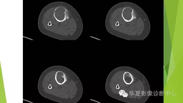 【病例】骨巨细胞瘤3例影像诊断与鉴别