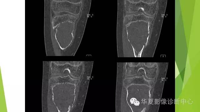 【病例】骨巨细胞瘤3例影像诊断与鉴别