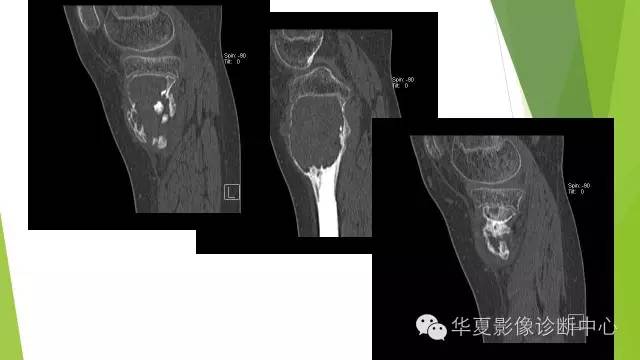 【病例】骨巨细胞瘤3例影像诊断与鉴别