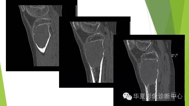 【病例】骨巨细胞瘤3例影像诊断与鉴别