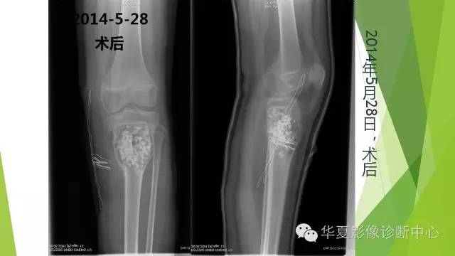 【病例】骨巨细胞瘤3例影像诊断与鉴别