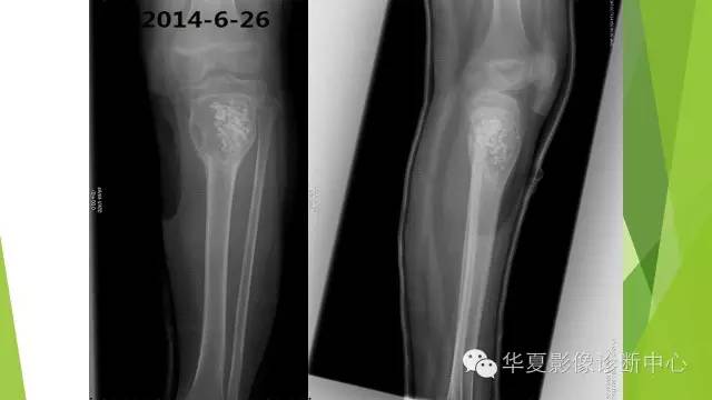 【病例】骨巨细胞瘤3例影像诊断与鉴别