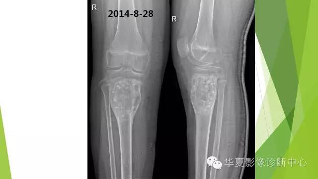 【病例】骨巨细胞瘤3例影像诊断与鉴别