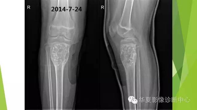 【病例】骨巨细胞瘤3例影像诊断与鉴别