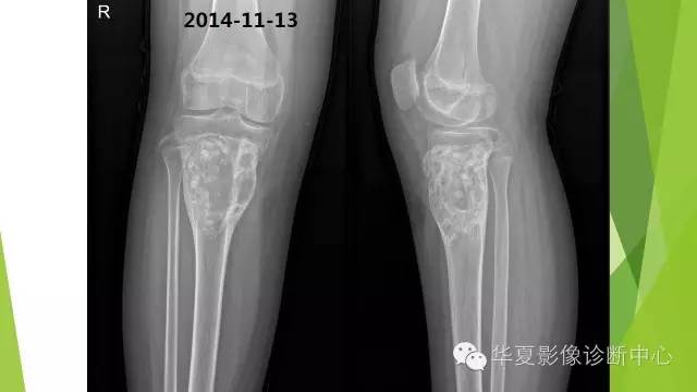 【病例】骨巨细胞瘤3例影像诊断与鉴别