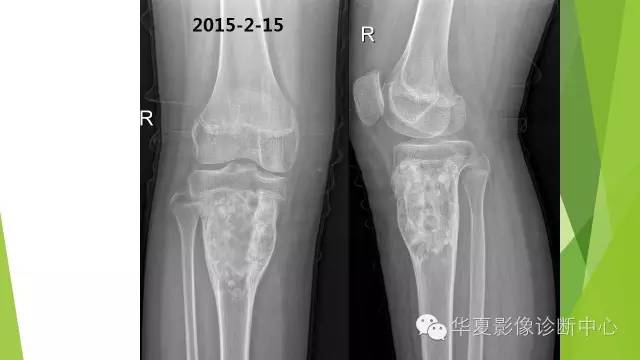【病例】骨巨细胞瘤3例影像诊断与鉴别