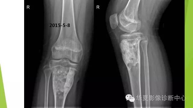 【病例】骨巨细胞瘤3例影像诊断与鉴别