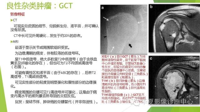 【病例】骨巨细胞瘤3例影像诊断与鉴别