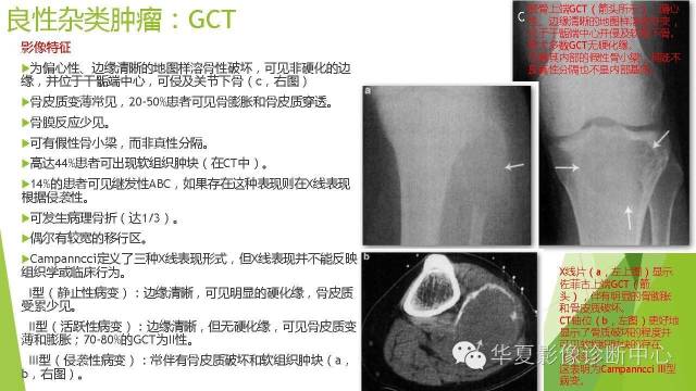 【病例】骨巨细胞瘤3例影像诊断与鉴别
