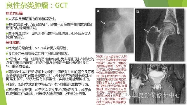 【病例】骨巨细胞瘤3例影像诊断与鉴别