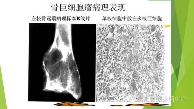 【病例】骨巨细胞瘤3例影像诊断与鉴别