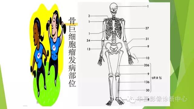 【病例】骨巨细胞瘤3例影像诊断与鉴别
