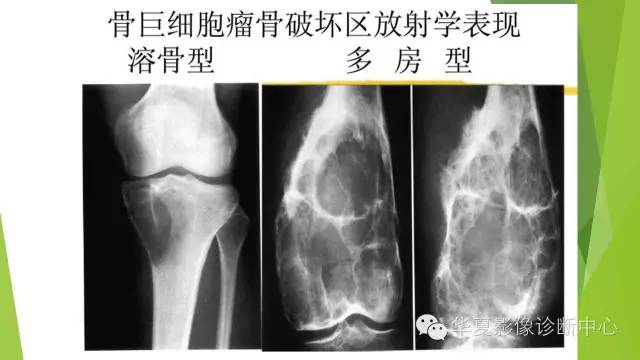 【病例】骨巨细胞瘤3例影像诊断与鉴别