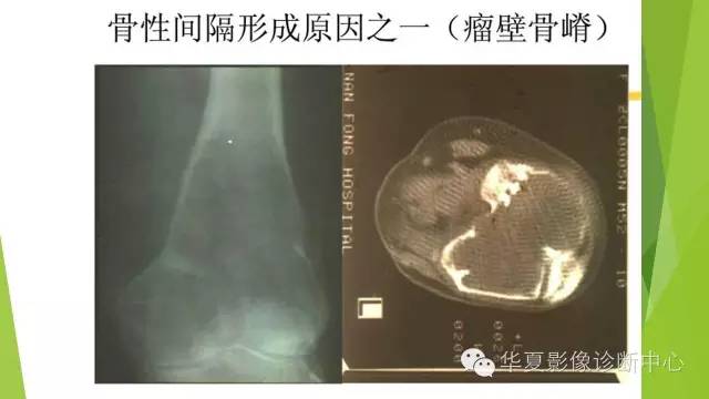 【病例】骨巨细胞瘤3例影像诊断与鉴别
