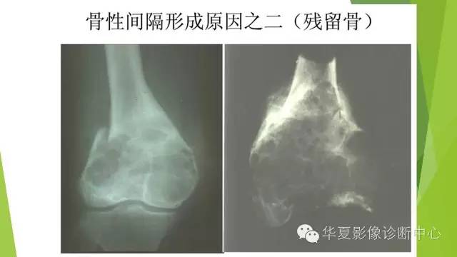 【病例】骨巨细胞瘤3例影像诊断与鉴别
