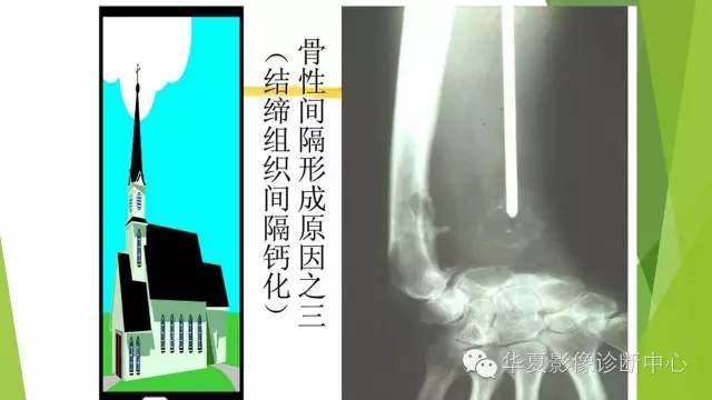 【病例】骨巨细胞瘤3例影像诊断与鉴别