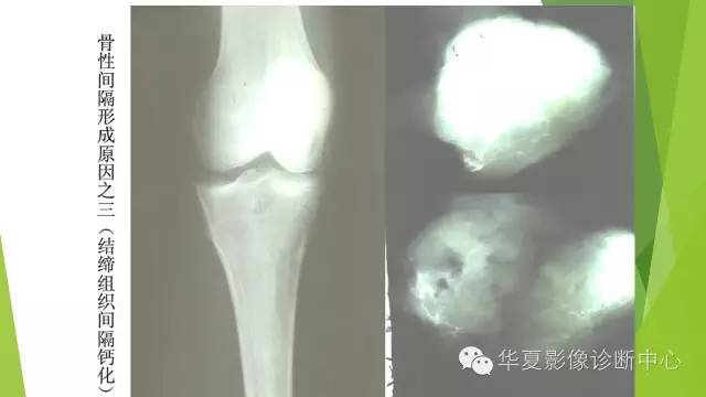 【病例】骨巨细胞瘤3例影像诊断与鉴别