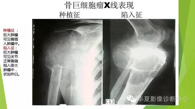 【病例】骨巨细胞瘤3例影像诊断与鉴别