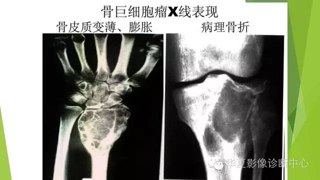 【病例】骨巨细胞瘤3例影像诊断与鉴别