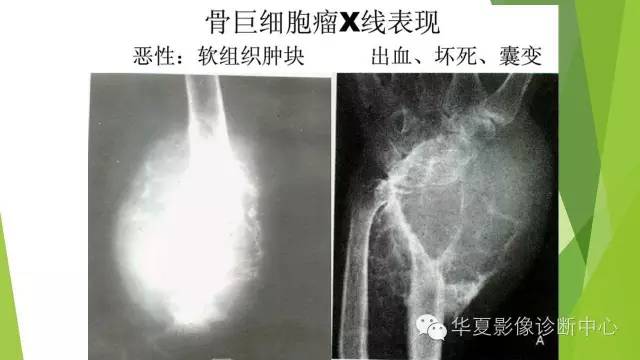 【病例】骨巨细胞瘤3例影像诊断与鉴别