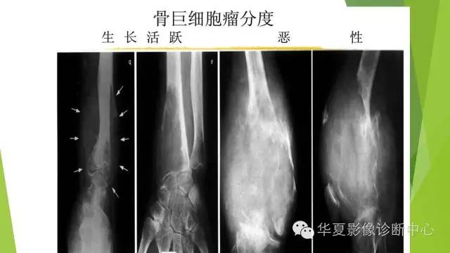 【病例】骨巨细胞瘤3例影像诊断与鉴别