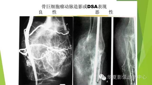 【病例】骨巨细胞瘤3例影像诊断与鉴别