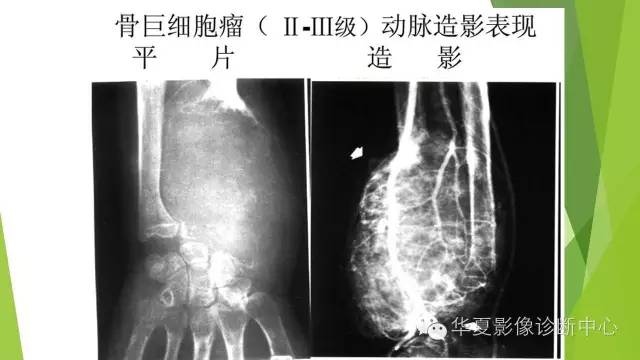 【病例】骨巨细胞瘤3例影像诊断与鉴别