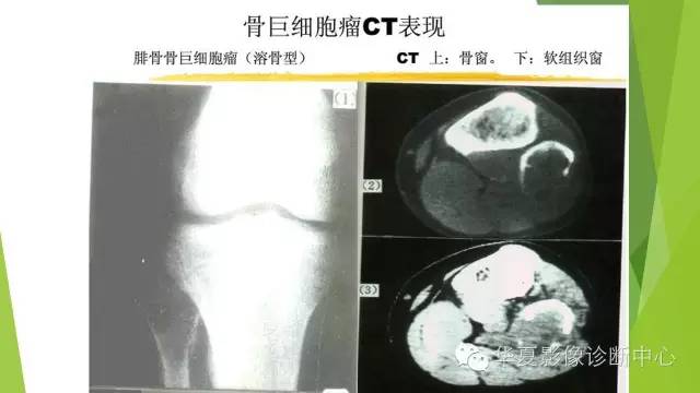【病例】骨巨细胞瘤3例影像诊断与鉴别
