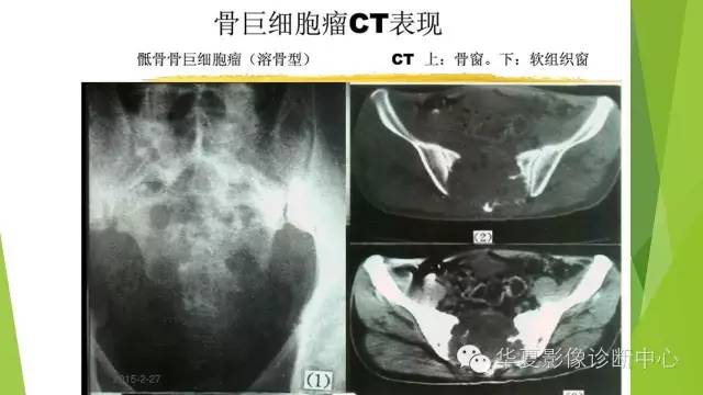 【病例】骨巨细胞瘤3例影像诊断与鉴别