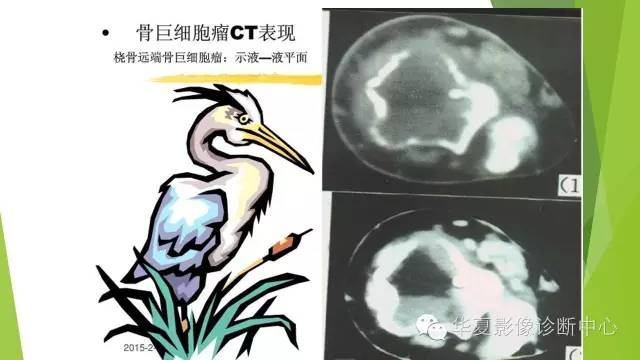 【病例】骨巨细胞瘤3例影像诊断与鉴别