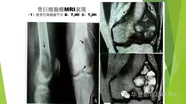 【病例】骨巨细胞瘤3例影像诊断与鉴别