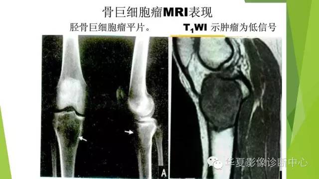 【病例】骨巨细胞瘤3例影像诊断与鉴别