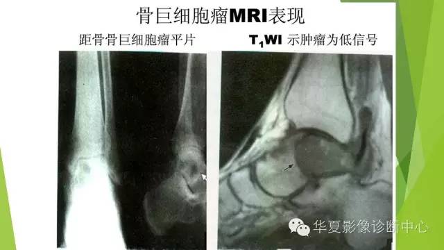 【病例】骨巨细胞瘤3例影像诊断与鉴别