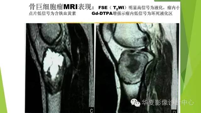 【病例】骨巨细胞瘤3例影像诊断与鉴别