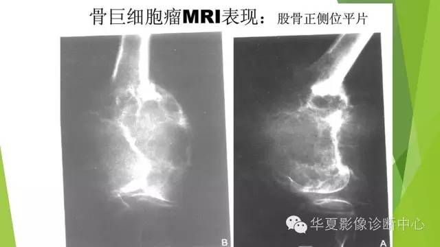 【病例】骨巨细胞瘤3例影像诊断与鉴别