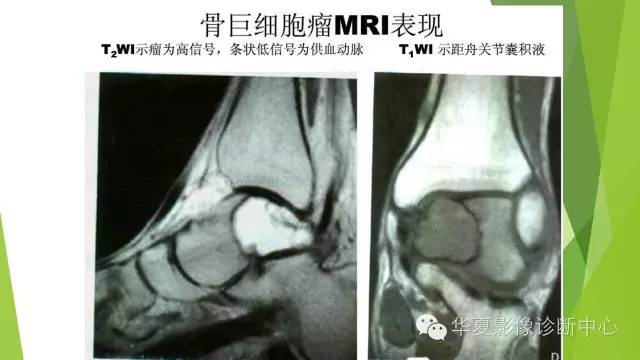 【病例】骨巨细胞瘤3例影像诊断与鉴别
