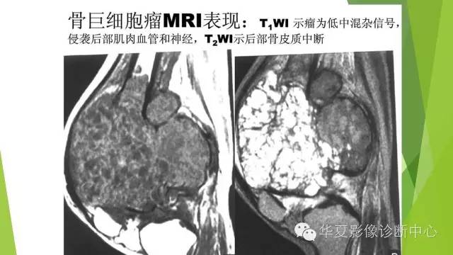 【病例】骨巨细胞瘤3例影像诊断与鉴别