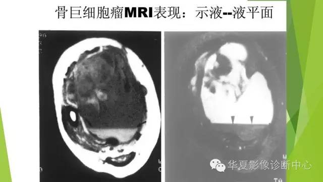 【病例】骨巨细胞瘤3例影像诊断与鉴别