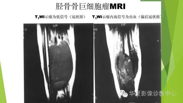 【病例】骨巨细胞瘤3例影像诊断与鉴别