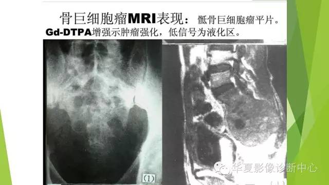 【病例】骨巨细胞瘤3例影像诊断与鉴别